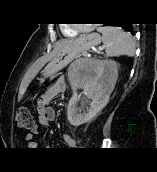File:Chromophobe renal cell carcinoma (Radiopaedia 84239-99519 D 38).jpg