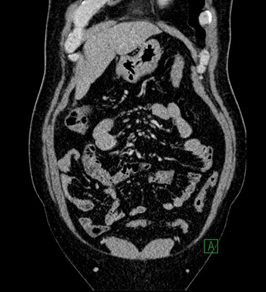 File:Chromophobe renal cell carcinoma (Radiopaedia 84286-99573 H 44).jpg