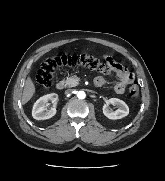 File:Chromophobe renal cell carcinoma (Radiopaedia 86879-103083 B 57).jpg