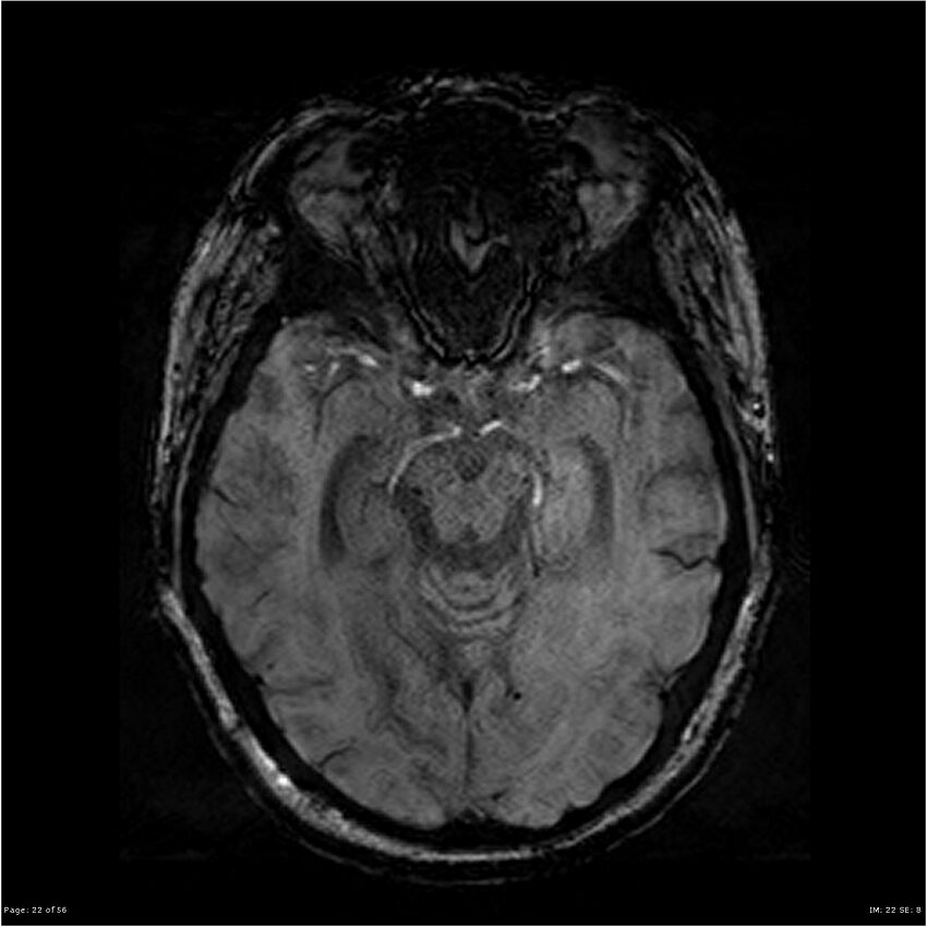 Chronic hypertensive encephalopathy (Radiopaedia 25764-25918 Axial SWI 22).jpg