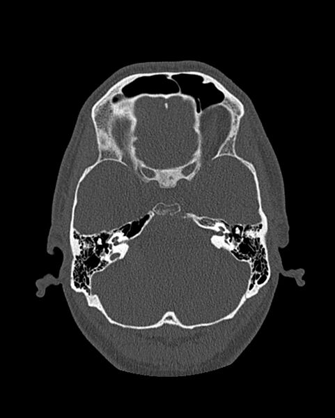 File:Chronic maxillary sinusitis caused by a foreign body (Radiopaedia 58521-65676 Axial bone window 253).jpg