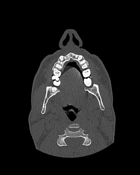 File:Chronic maxillary sinusitis caused by a foreign body (Radiopaedia 58521-65676 Axial bone window 7).jpg