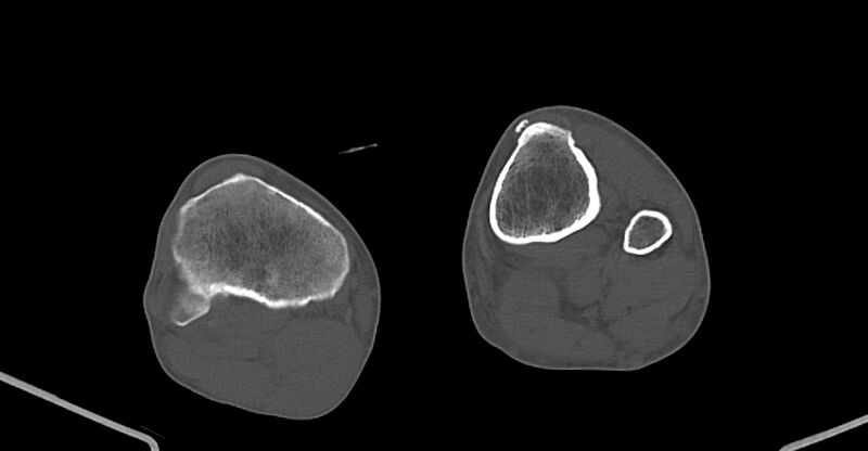 File:Chronic osteomyelitis (with sequestrum) (Radiopaedia 74813-85822 Axial non-contrast 205).jpg