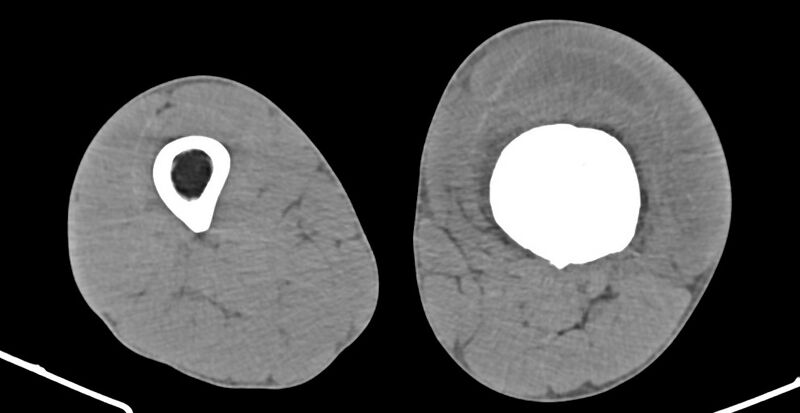 File:Chronic osteomyelitis (with sequestrum) (Radiopaedia 74813-85822 D 123).jpg