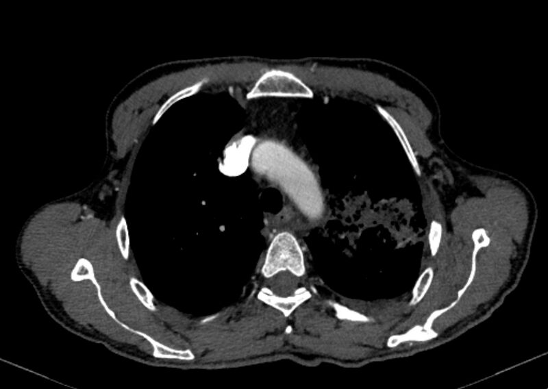 File:Chronic pulmonary embolism with bubbly consolidation (Radiopaedia 91248-108850 C+ arterial phase 31).jpg