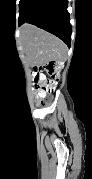 File:Chronic small bowel volvulus (Radiopaedia 75224-86322 C 124).jpg