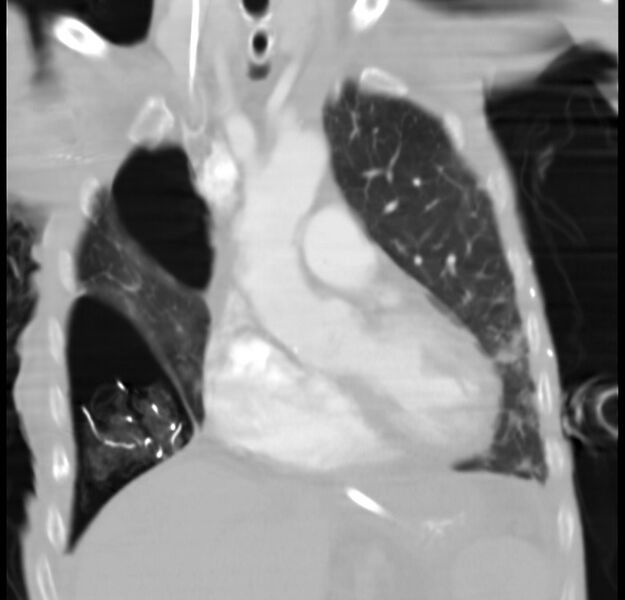 File:Clagett thoracotomy with bronchopleural fistula (Radiopaedia 29192-29587 Coronal lung window 21).jpg