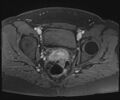 Class II Mullerian duct anomaly- unicornuate uterus with rudimentary horn and non-communicating cavity (Radiopaedia 39441-41755 Axial T1 fat sat 89).jpg