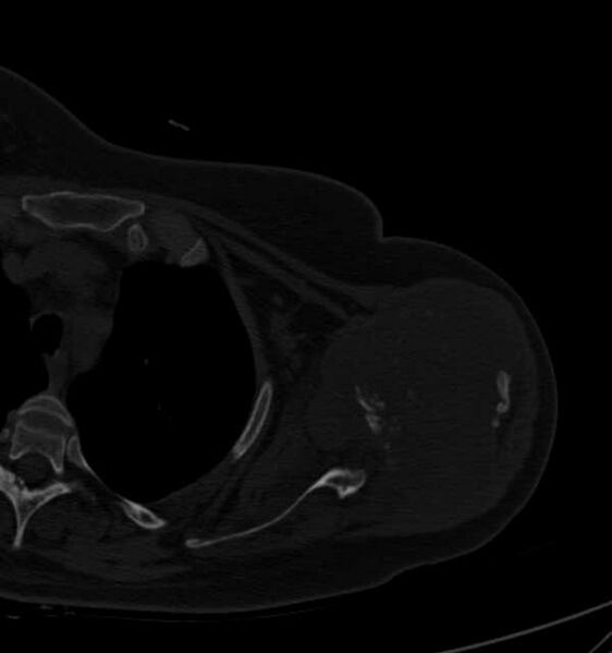 File:Clear cell chondrosarcoma - humerus (Radiopaedia 63104-71612 Axial bone window 45).jpg
