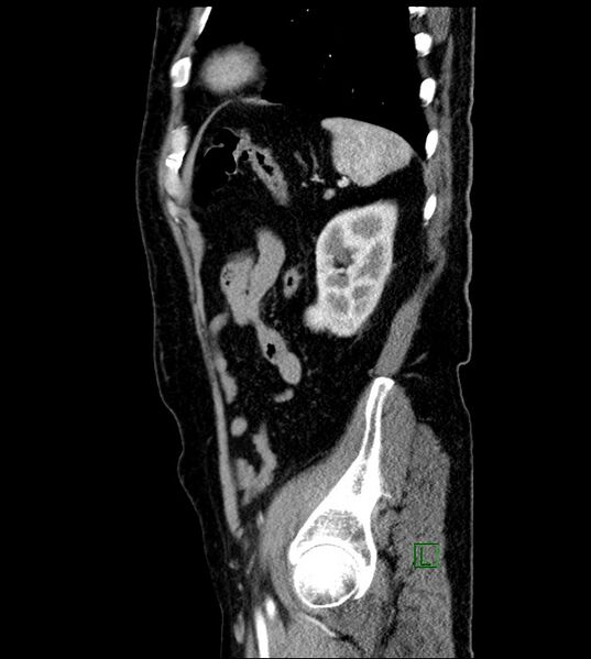 File:Clear cell renal cell carcinoma (Radiopaedia 85006-100539 E 13).jpg