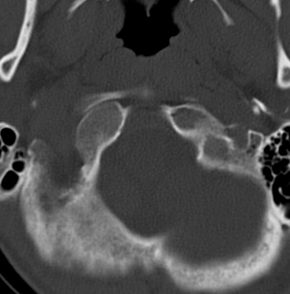 File:Cleft of the posterior arch of C1 mimicking fracture (Radiopaedia 40201-42721 Axial bone window 20).jpg