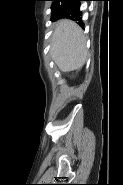 File:Closed loop bowel obstruction and ischemia (Radiopaedia 86959-103180 C 62).jpg