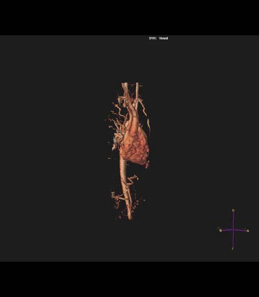 File:Coarctation of the aorta (Radiopaedia 43373-46729 3D reconstruction 29).jpg