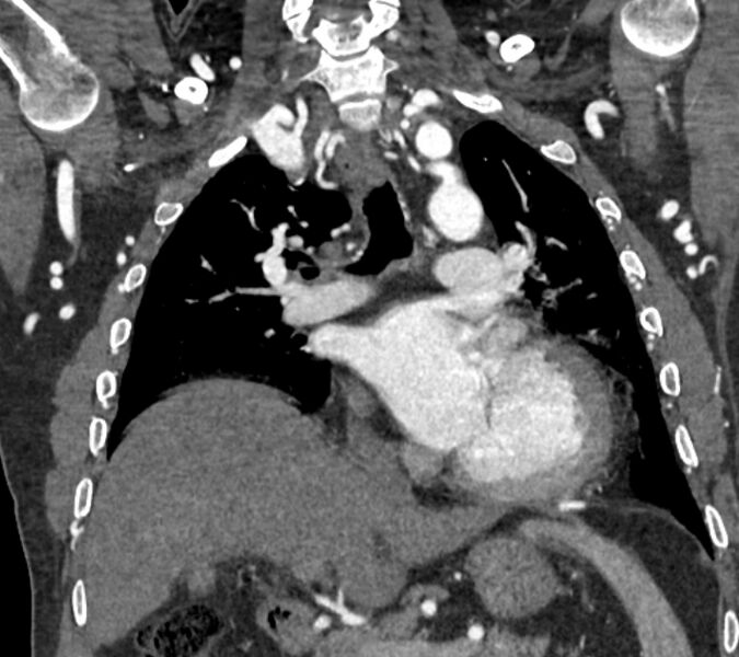 File:Coarctation of the aorta (Radiopaedia 53752-59822 B 41).jpg