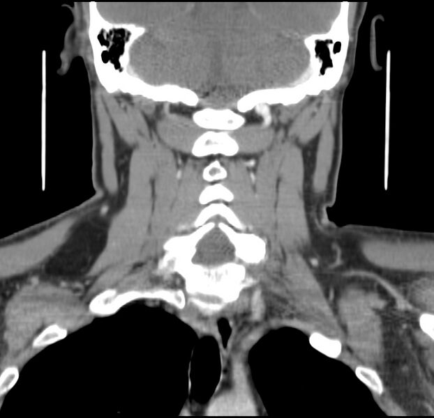 File:Colloid cyst of thyroid (Radiopaedia 22897-22923 Coronal C+ delayed 41).jpg