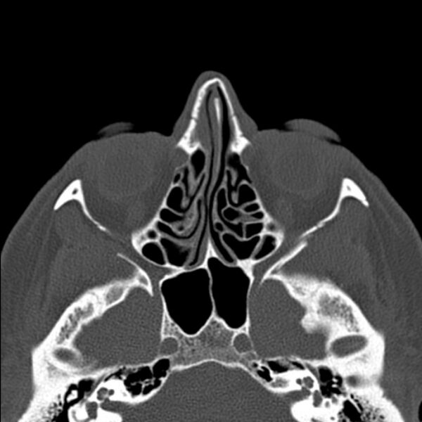 File:Nasal septal perforation (Radiopaedia 25030-25289 Axial bone window 31).jpg
