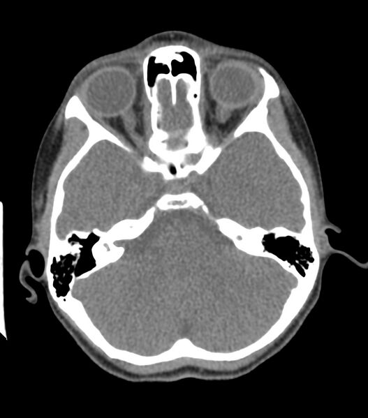 File:Nasoorbitoethmoid fracture (Radiopaedia 90044-107205 Axial non-contrast 167).jpg