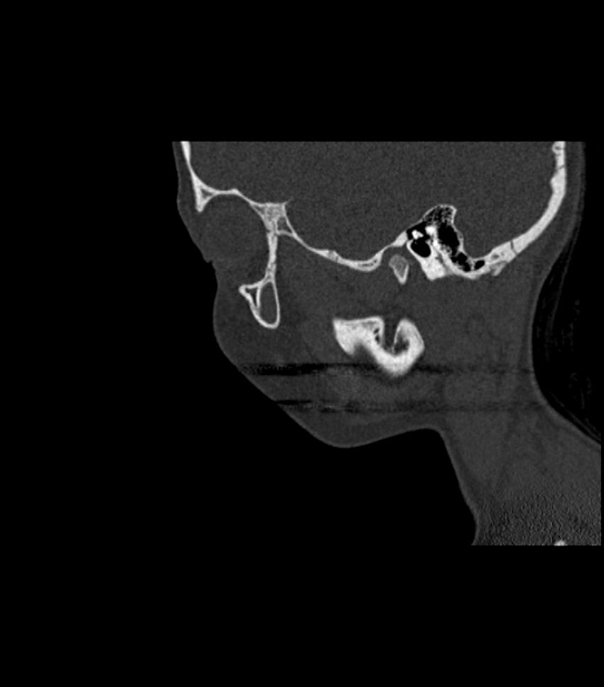 Nasoorbitoethmoid fracture (Radiopaedia 90044-107205 Sagittal bone window 112).jpg