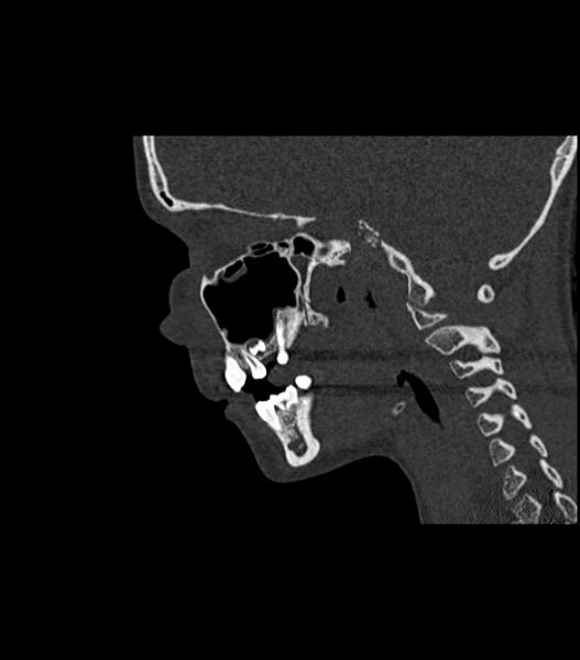File:Nasoorbitoethmoid fracture (Radiopaedia 90044-107205 Sagittal bone window 60).jpg