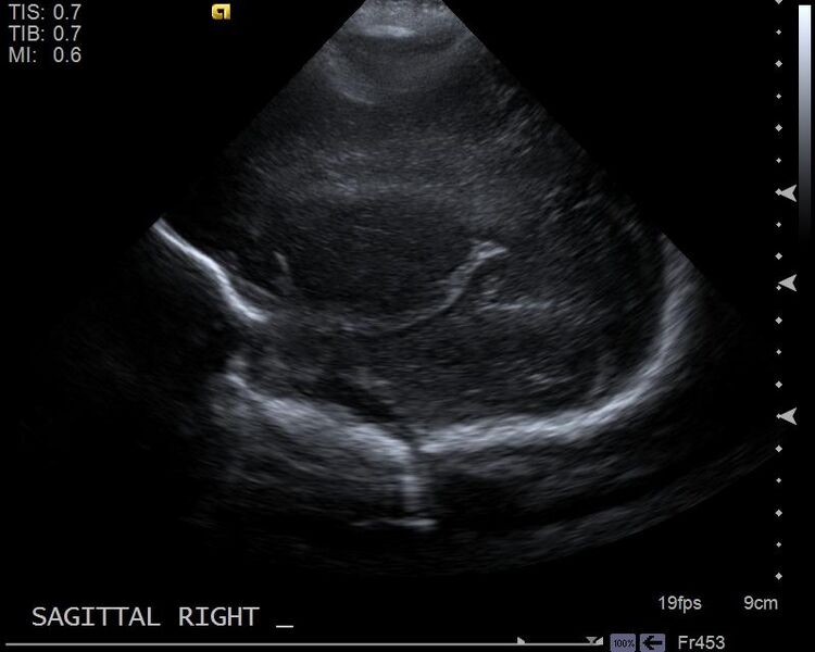 File:Neonatal intracranial hemorrhage - grade 3 (Radiopaedia 27279-27455 Longitudinal 3).jpg