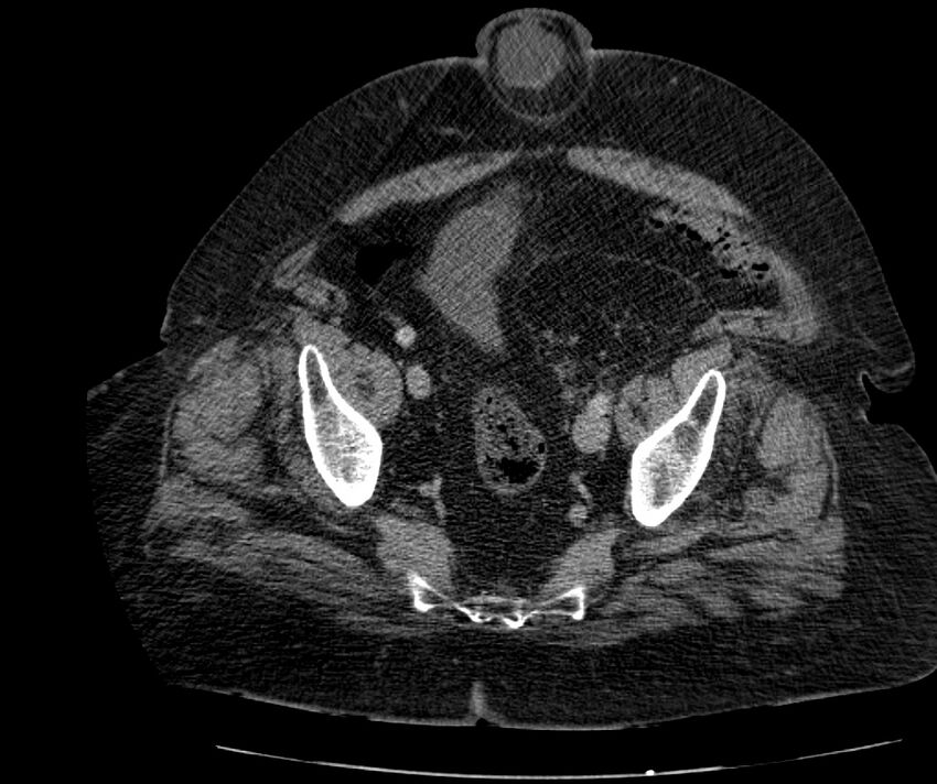Nephroptosis with inguinal hernia containing perirenal fat (Radiopaedia 56632-63391 C 288).jpg