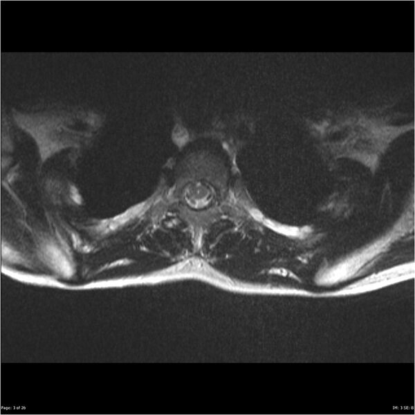 File:Neurofibromatosis type 1 (Radiopaedia 22541-22565 Axial T2 3).jpg