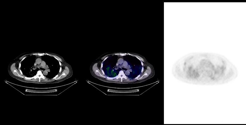 File:Non-Hodgkin lymphoma involving seminal vesicles with development of interstitial pneumonitis during Rituximab therapy (Radiopaedia 32703-33761 ax CT Fus PET 15).jpg