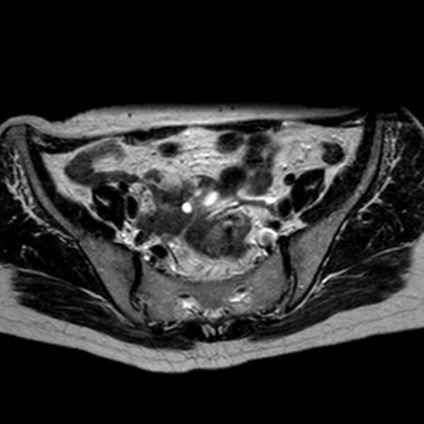 File:Non-puerperal uterine inversion (Radiopaedia 78343-90983 Axial T2 28).jpg