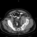 Non Hodgkin lymphoma in a patient with ankylosing spondylitis (Radiopaedia 84323-99621 Axial non-contrast 54).jpg