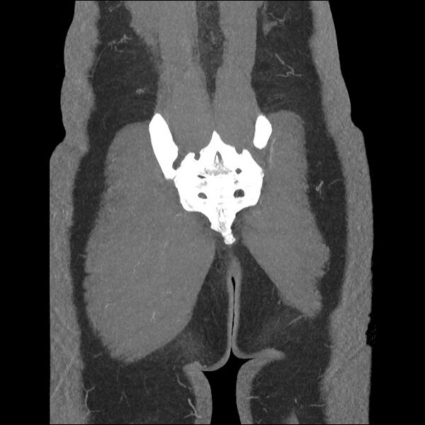 File:Normal CT angiogram of pelvis (Radiopaedia 45390-49430 B 42).jpg