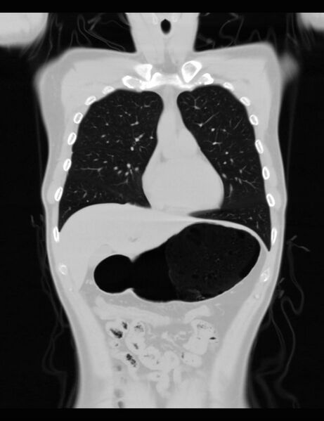 File:Normal CT virtual gastroscopy (Radiopaedia 29960-30501 F 15).jpg
