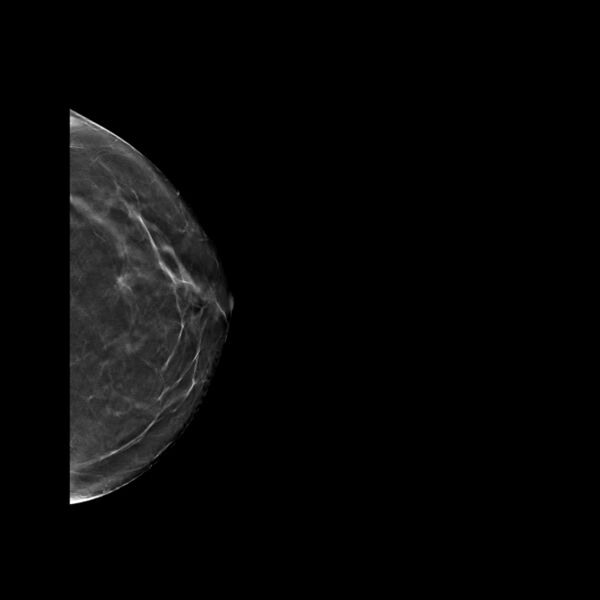 File:Normal breast mammography (tomosynthesis) and ultrasound (Radiopaedia 65325-74353 LCC Tomo 32).jpeg