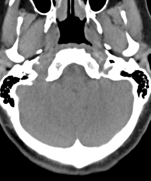 File:Normal cervical spine MRI (including Dixon) (Radiopaedia 42762-45926 Axial non-contrast 4).png