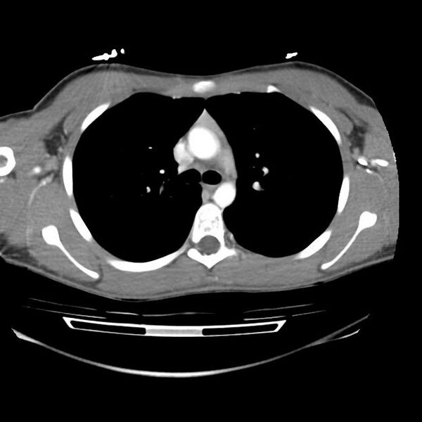 File:Normal dual-phase trauma CT chest,abdomen and pelvis (Radiopaedia 48092-52899 A 20).jpg