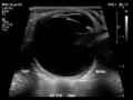 Normal eye ultrasound (Radiopaedia 70415-80514 A 1).jpg