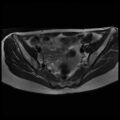 Normal female pelvis MRI (retroverted uterus) (Radiopaedia 61832-69933 Axial T2 14).jpg
