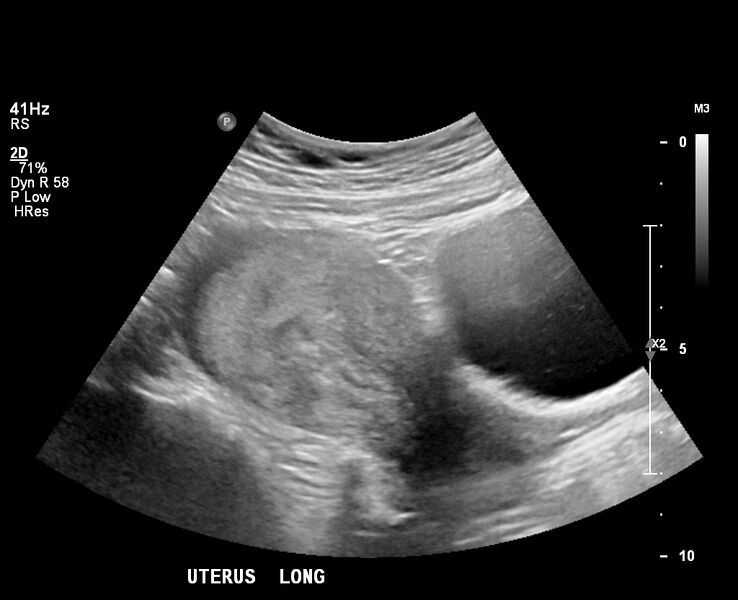 File:Normal first trimester pregnancy (Radiopaedia 76936).jpg