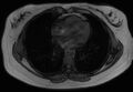 Normal liver MRI with Gadolinium (Radiopaedia 58913-66163 B 34).jpg