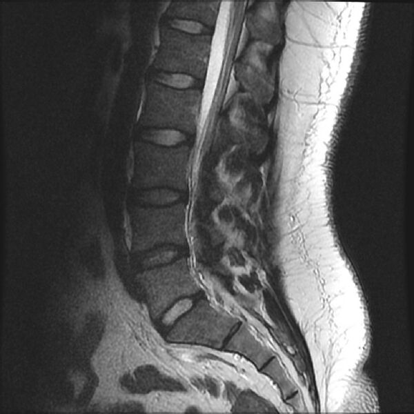 File:Normal lumbar spine MRI (Radiopaedia 43051-46311 Sagittal T2 9).jpg