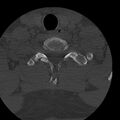 Occipital condyle fracture (Radiopaedia 31755-32691 Axial bone window 71).jpg