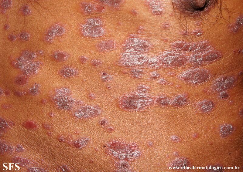 File:Psoriasis (Dermatology Atlas 137).jpg