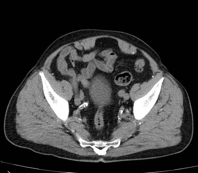 File:Abdominal aortic aneurysm (Radiopaedia 22421-22458 non-contrast 47).jpg