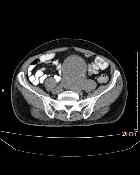 File:Abdominal aortic aneurysm (Radiopaedia 25985-26121 Axial non-contrast 22).jpg