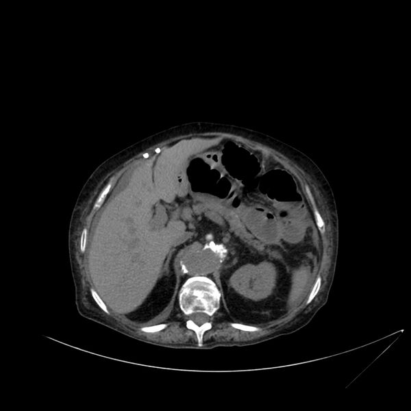 File:Abdominal aortic aneurysm - impending rupture (Radiopaedia 19233-19246 Axial non-contrast 38).jpg