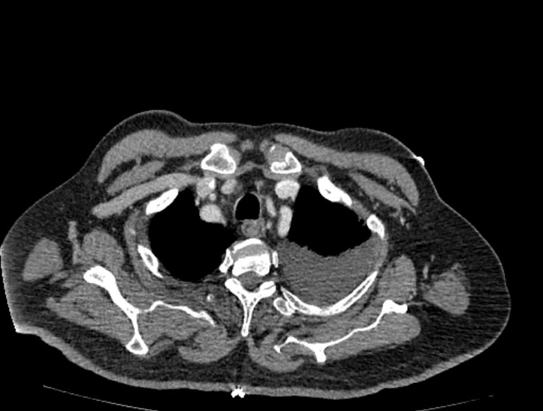 File:Abdominal aortic aneurysm rupture (Radiopaedia 54179-60362 Axial C+ portal venous phase 52).jpg