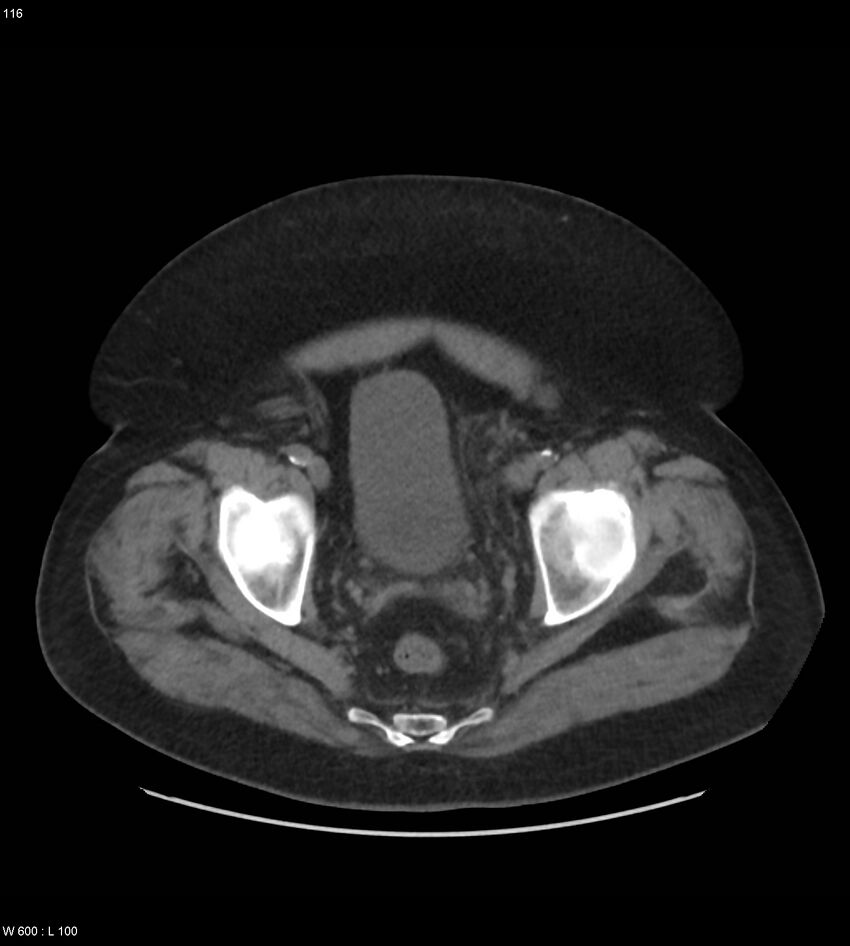 Abdominal aortic aneurysm with intramural hematoma then rupture (Radiopaedia 50278-55631 Axial non-contrast 112).jpg