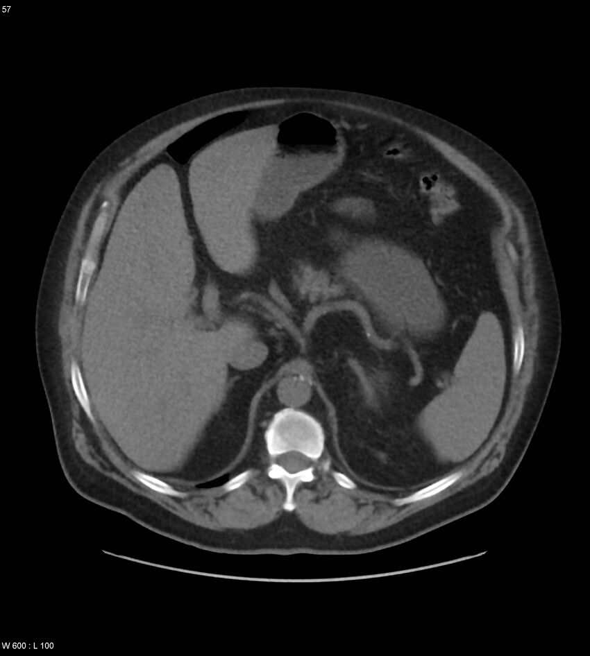 Abdominal aortic aneurysm with intramural hematoma then rupture (Radiopaedia 50278-55631 Axial non-contrast 53).jpg