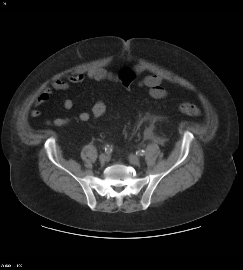 Abdominal aortic aneurysm with intramural hematoma then rupture (Radiopaedia 50278-55631 Axial non-contrast 97).jpg