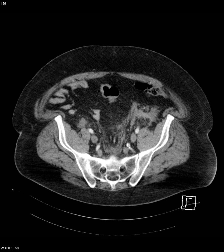 Abdominal aortic aneurysm with intramural hematoma then rupture (Radiopaedia 50278-55632 Axial C+ arterial phase 135).jpg