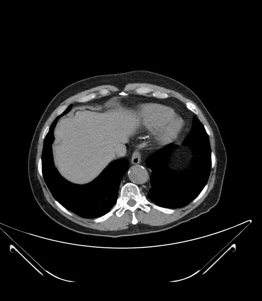 File:Abdominal aortic aneurysm with thrombus fissuration (Radiopaedia 46218-50618 Axial non-contrast 6).jpg